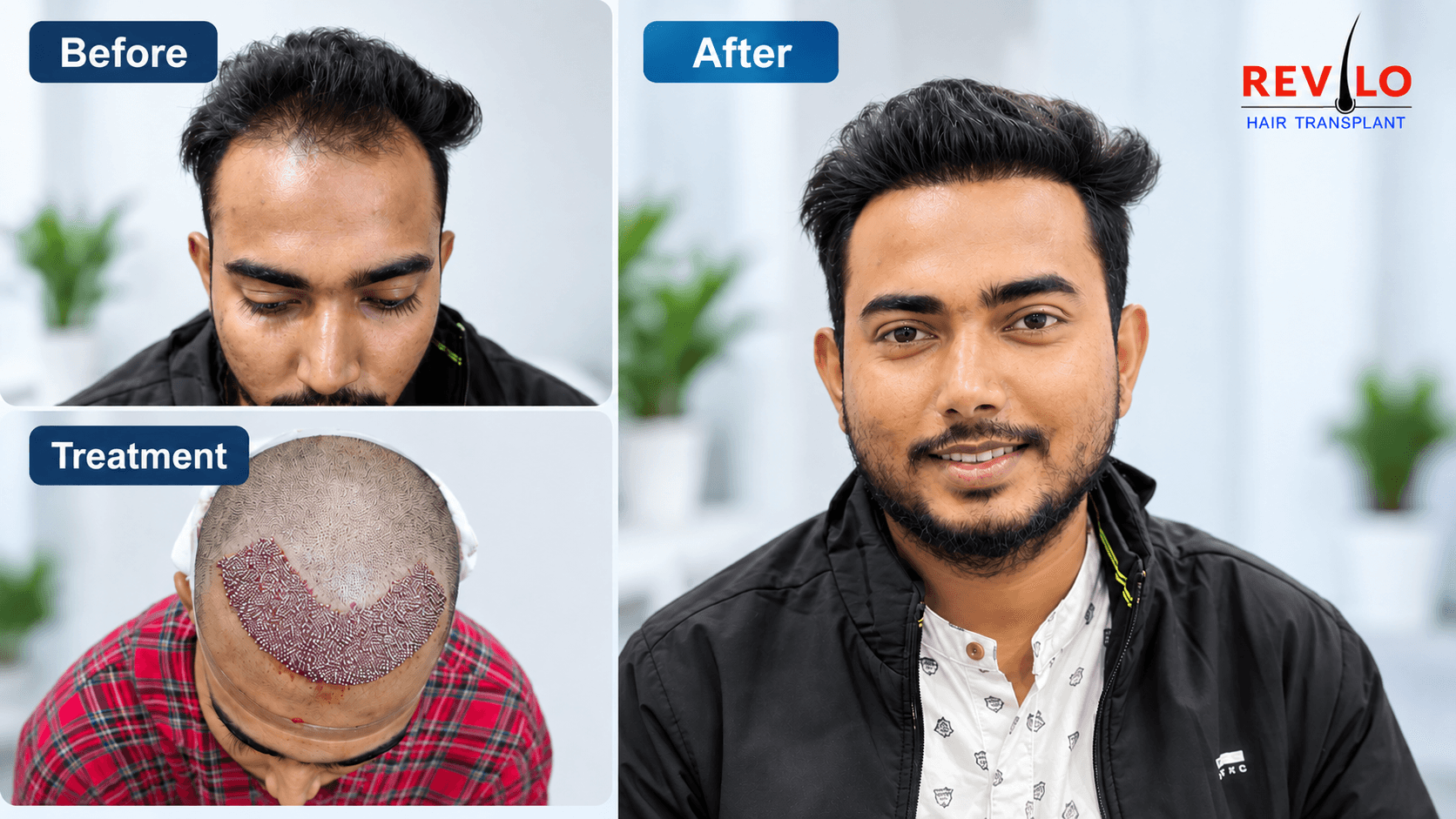 Revilo patient result 03
