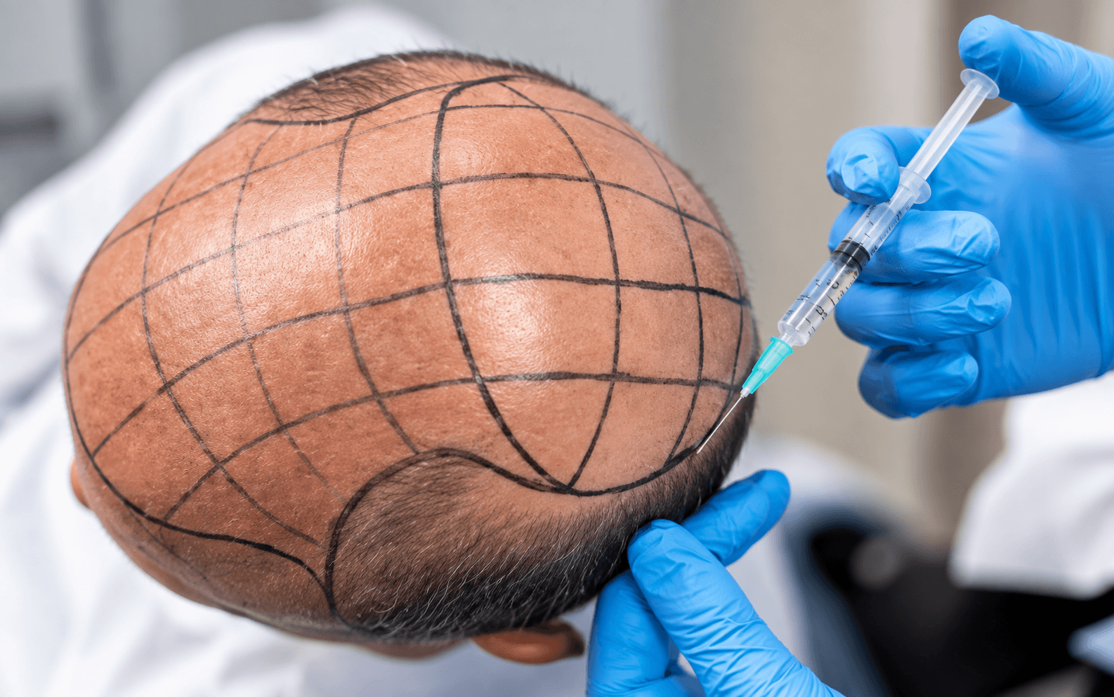 Follicular Unit Extraction